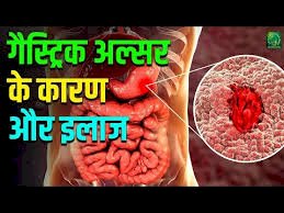 गैस्ट्रिक अल्सर (GASTRIC ULCER)